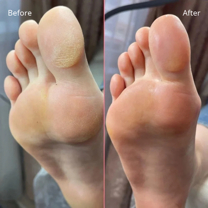 New York - Electric Callus Remover – Soft Feet at Home