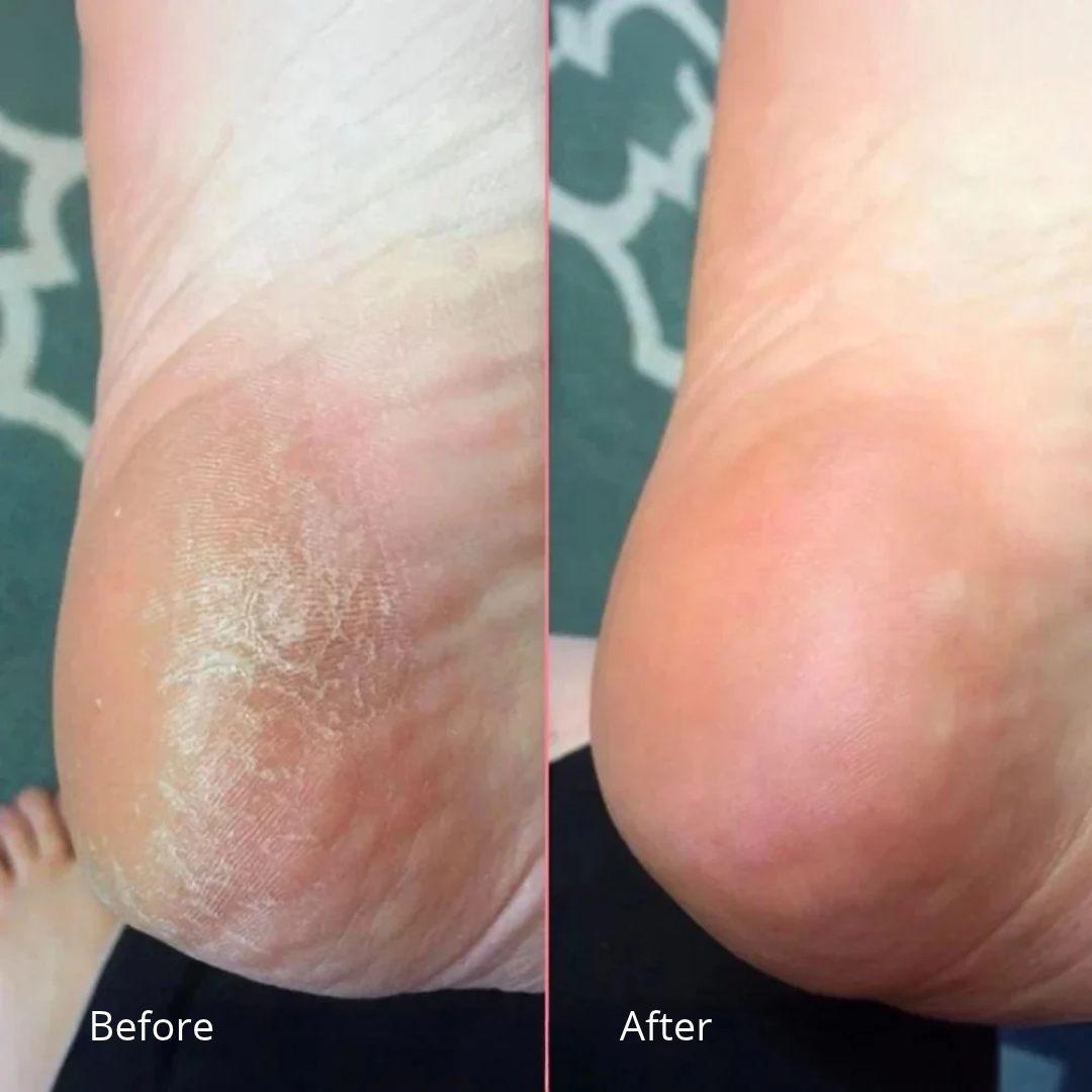 New York - Electric Callus Remover – Soft Feet at Home